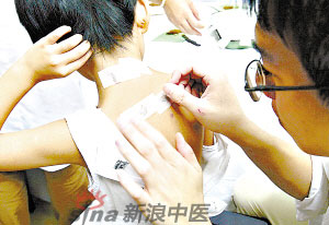 灸法的種類  你知道多少？